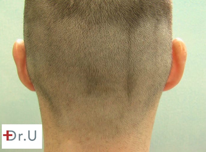 Dr. U uses his FUE Shave Test to determine whether or not a patient is a good candidate for FUE hairline surgery using nape hair. Dr. U uses his FUE Shave Test to determine whether or not a patient is a good candidate for a FUE hairline surgery using nape hair.