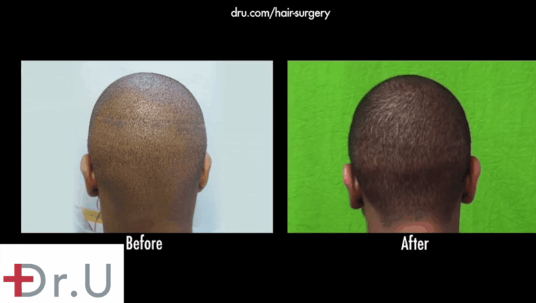 hair loss in black men should be addressed with advanced FUE performed with tools like the Dr.UPunch Curl™ to avoid the creation of linear strip scars. However, with the right FUE procedures, it is possible to insert hair follicle grafts into the scar tissue to render it less visible, enabling successful hair transplant repair in African American individuals 
