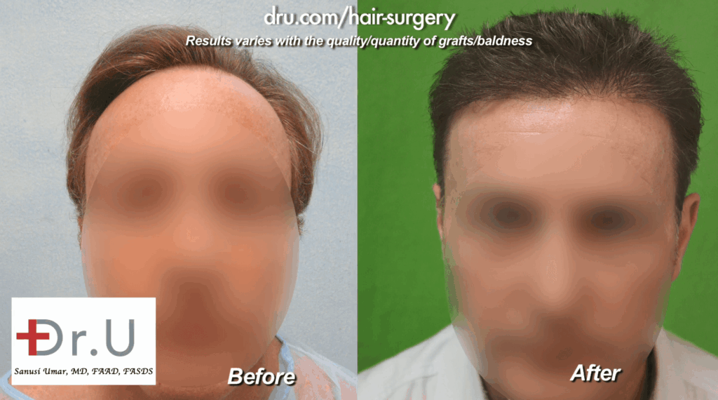 Using the Dr. UPunch Rotor™, Dr. Umar successfully extracted 3,500 grafts from the head and nape, which he then used to construct a more youthful, natural-looking hairline with carefully positioned and angled temple points to suit the patient's facial structure.* Using the Dr. UPunch Rotor™, Dr. Umar sucessfully extracted 3,500 grafts from the head and nape, which he then used to construct a more youthful, natural looking hairline with carefully positioned and angled temple points to suit the patient's facial structure.