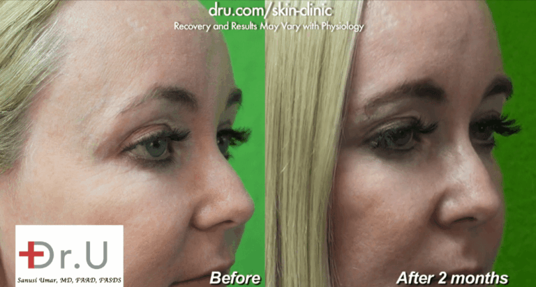 Botox was used as a crows feet treatment to improve the appearance of minor lines around the patient's eyes and to prevent existing wrinkles in this area from becoming deeper