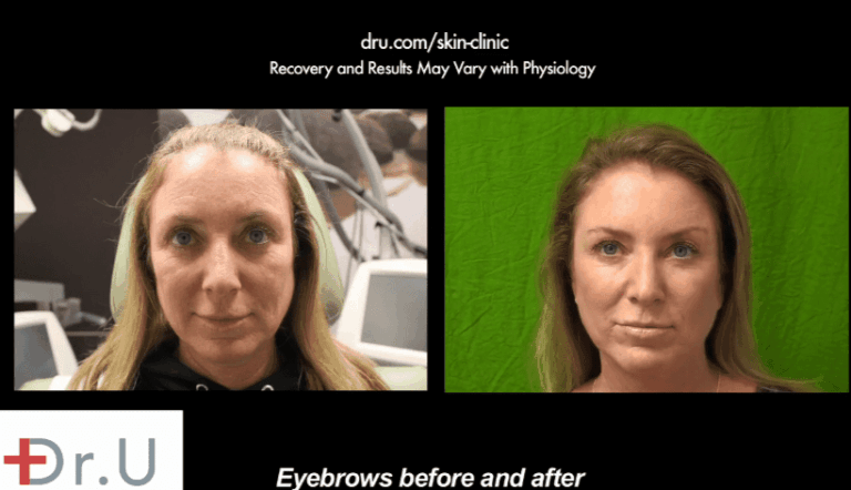 As neuromuscular injections, Botox Dysport and Xeomin can relax a certain set of eyebrow muscles in order to activate the opposite pair. Botox was used in this fashion to raise this patient's droopy brows