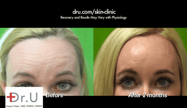 Botox, Dysport and Xeomin can all be considered for treating horizontal forehead creases. For this particular patient, Botox was used to relax the muscles responsible for these wrinkles. 