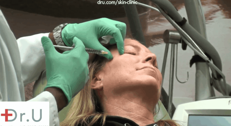 Dr. Umar's patient receiving Botox treatment as a crows feet treatment and to address other concerns like frown lines, forehead wrinkles and droopy eyebrows