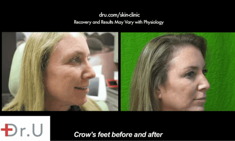 This patient of Dr. Umar benefited from the use of Botox as a crows feet treatment which drastically reduced the appearance of creases in this area, even when her face is at rest 