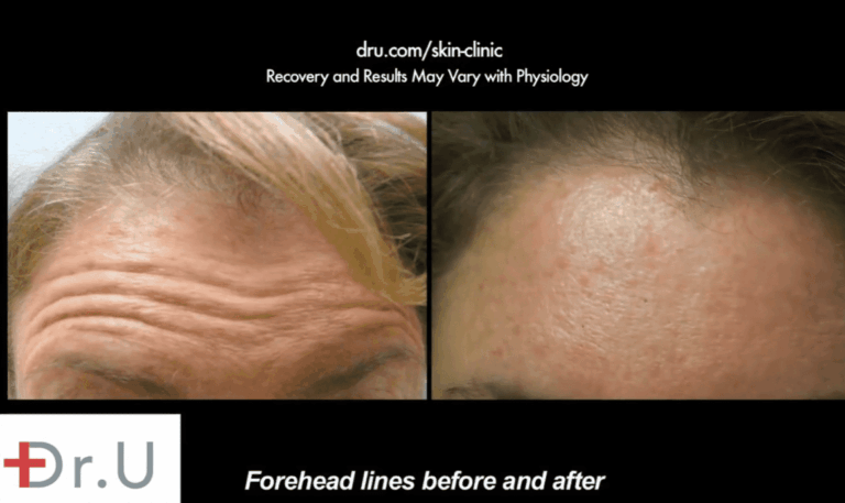 Dr. Umar used Botox to help this patient achieve a smoother, tighter, more youthful looking forehead. This is notably shown in these side by side comparison photos