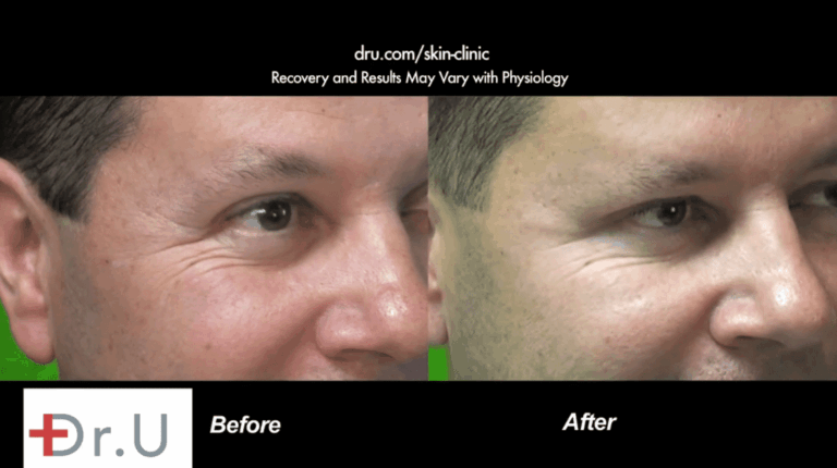 This male patient's crows feet treatment using Dysport helped reduce the number of branching lines around the outer corners of his eyes