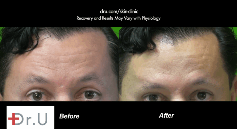 Dysport was used to improve the appearance of forehead lines on this patient's forehead. These before and after photos show a fewer number of wrinkles and a smoother looking forehead