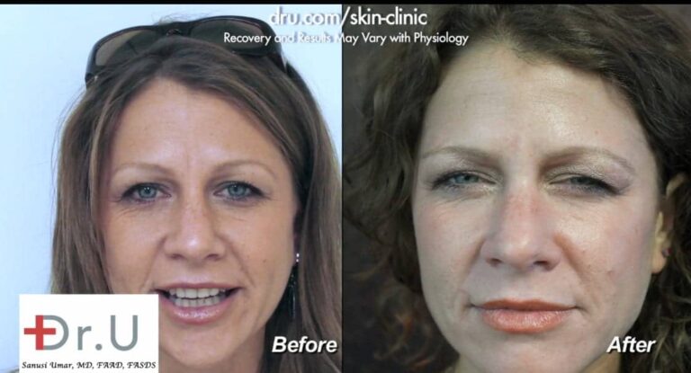 Dysport was used as a treatment to help get rid of a single frown line groove in between the patient's eyebrows. The line is much softer following her procedure even when her face is stationary 