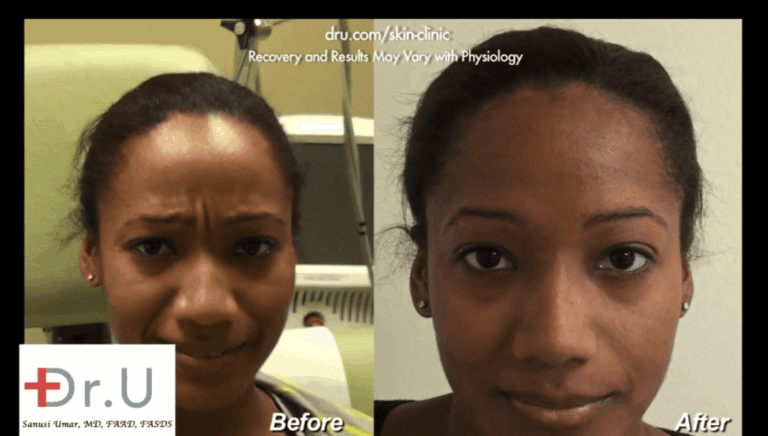 Dr. Umar's patient shows intense muscle contraction between her brows. Dysport did an amazing job to get rid of the frown lines in this area which transformed her facial expression.