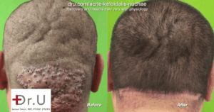 Surgery to Remove AKN Razor Bump/Large Barber's Rash on the Back of the Neck Completely