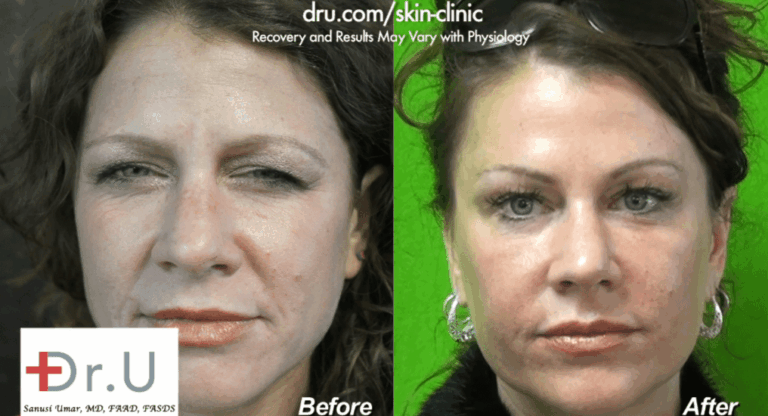 Redondo Beach patient is pleased with her natural looking lip augmentation outcome. This was achieved through a conservative use of filler and the thoughtful placement of the injections Redondo Beach patient is pleased with her natural looking lip augmentation outcome. This was achieved through a conservative use of filler and the thoughtful placement of the injections