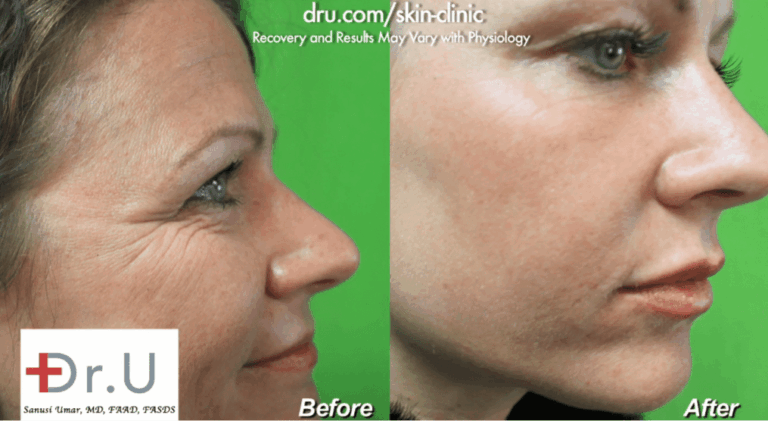 The balanced application of products like Juvederm is key to the question of how to avoid duck lips with fillers The balanced application of products like Juvederm is key to the question of how to avoid duck lips with fillers