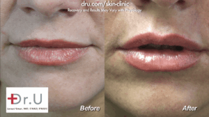 Before and after photos of a lip augmentation for the cupid's bow