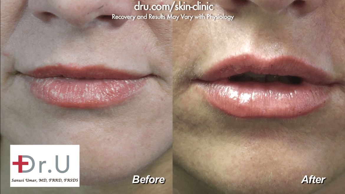 A lip augmentation for the cupid's bow produced a very flattering end result for this patient How to avoid duck lips with fillers? Beautiful, natural looking volume through lip augmentation at Dr. U Skin Clinic.*