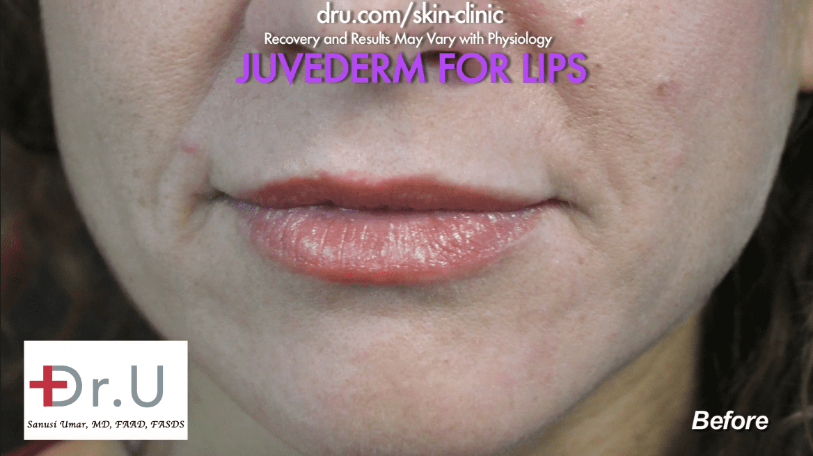 This patient sought a natural looking lip augmentation outcome. This patient sought a natural looking lip augmentation outcome.
