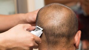 Have you noticed bumps on your head after a shave? While it may be tempting to brush off these bumps as just a barber's rash, they could be symptoms of a skin condition known as AKN.