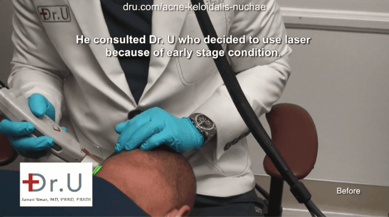 Dr. Umar treats this patient's itchy bumps on the head with laser therapy, since the condition was caught early on. 