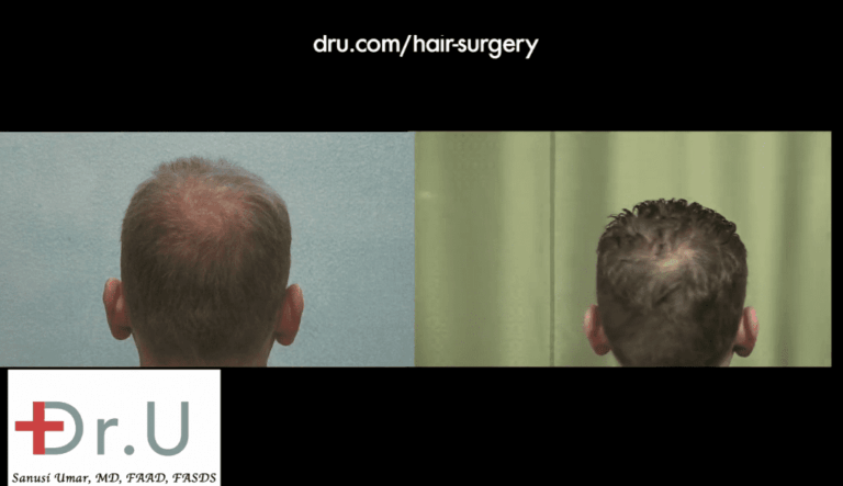 FUE for crown baldness is one of the areas targeted in this patient's procedure with Dr. U