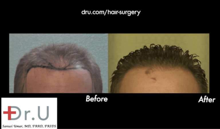 Hollywood, Los Angeles patient before and after his FUE hairline reconstruction with 3500 grafts 
