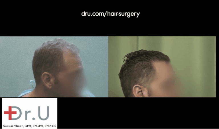 A hair restoration on your 20s may involve the hairline, temples and crown as this patient shows in these before and after images 