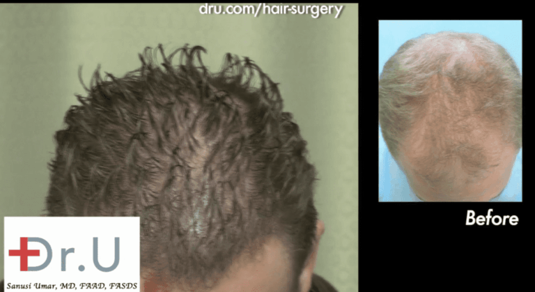 Patient shown before and after his FUE hair transplant to reverse hair thinning