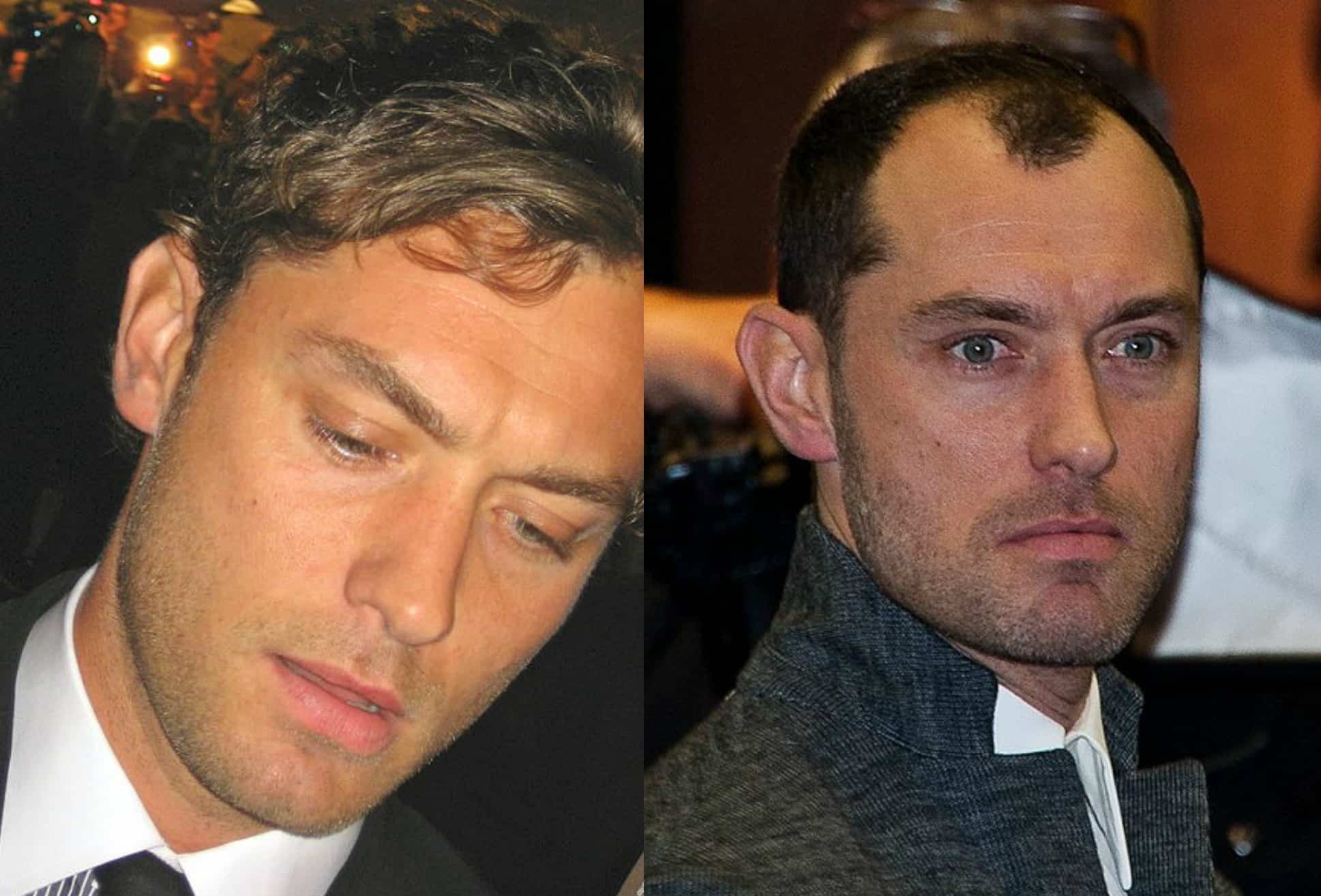 Actor Jude Law showing significant hair loss compared to his younger years and is one of many examples of celebrities with receding hairlines
