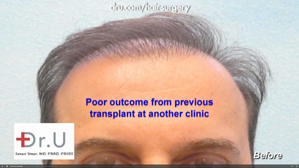 This patient chose Dr. Umar to fix a pluggy hairline that resulted from a past hair transplant procedure