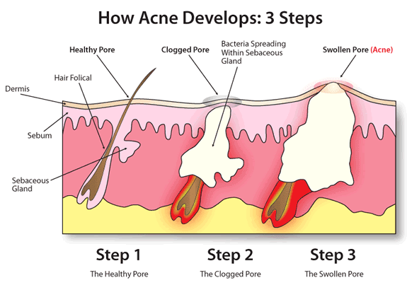 Photodynamic acne treatment fights stubborn pimples that won’t go away.*