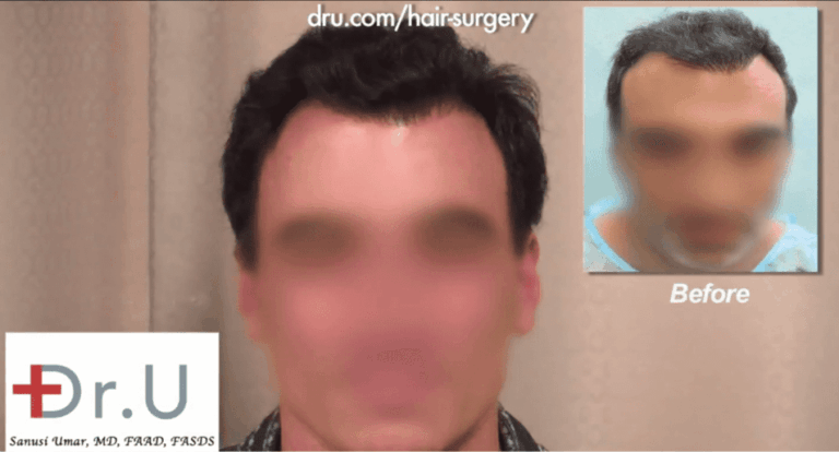 Palos Verdes, Los Angeles patient before and after his asymmetrical hairline repair