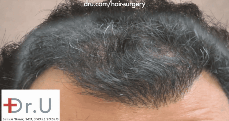 Palos Verdes, Los Angeles patient before his repair for an asymmetrical hairline