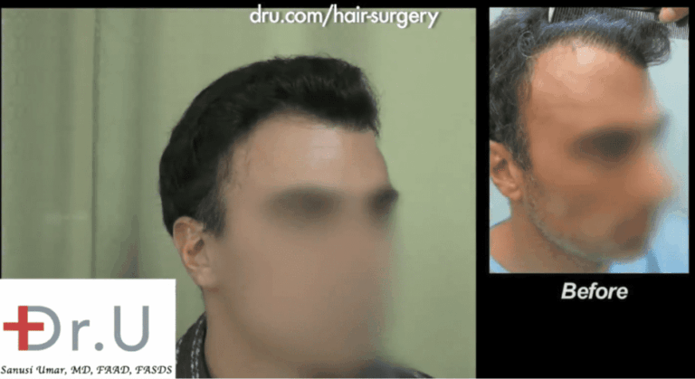 Palos Verdes patient showing the results of his hairline revision surgery which also included improvements in his temple area