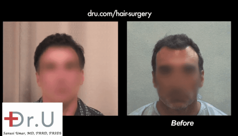 asymmetrical pluggy hairline repair, fix a botched hairline, how to fix a crooked hairline, hairline repair with FUE, hairline revision surgery