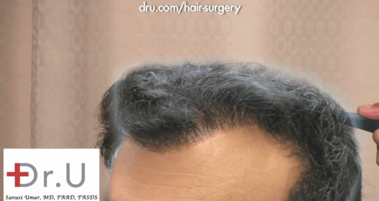 Patient before his temple and hairline revision surgery with FUE