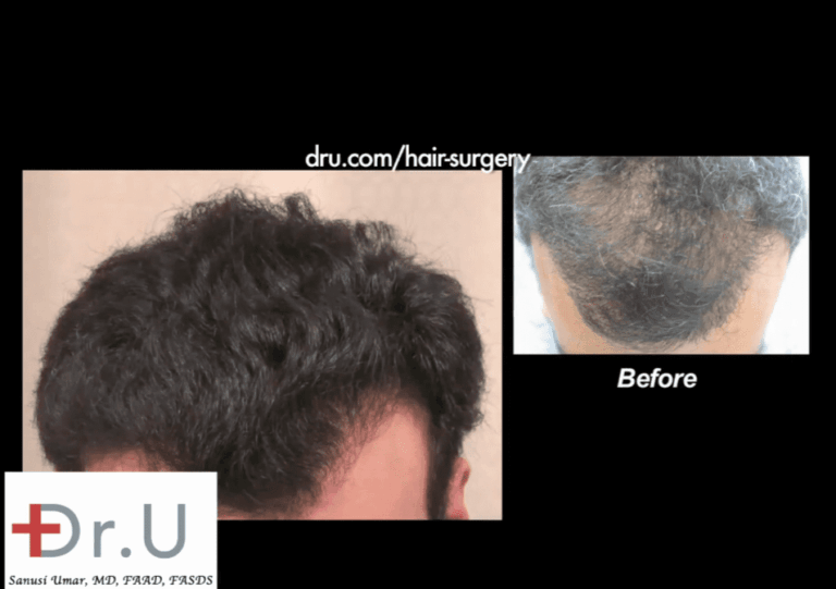 Dr. Umar's hairline repair with FUE also included addressing other areas like the sparse top shown here