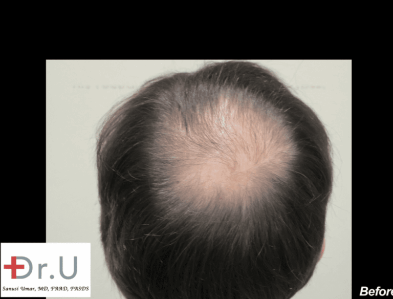 Bernardo hoped to restore a balding crown on the back of his head