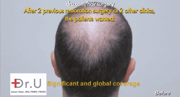 Despite undergoing two past procedures, this patient struggled with no growth after strip surgery