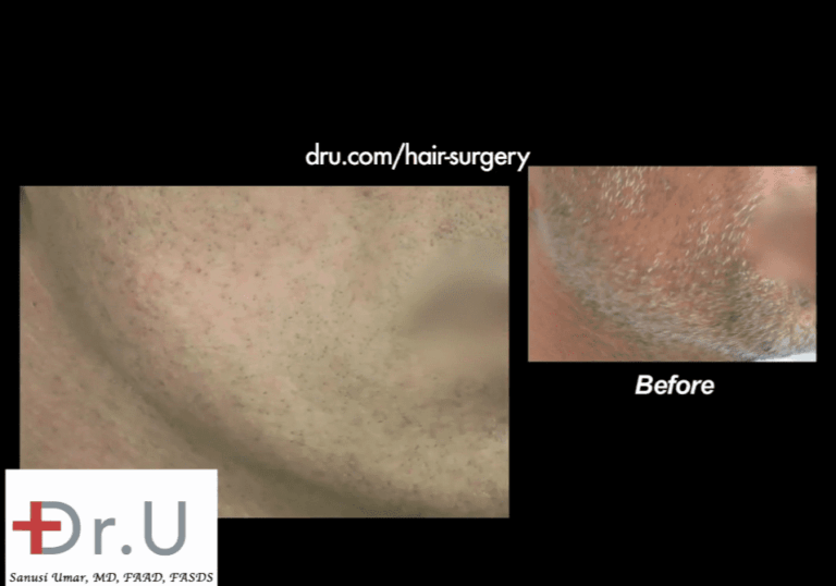 Patient's beard donor area shows amazing healing results 