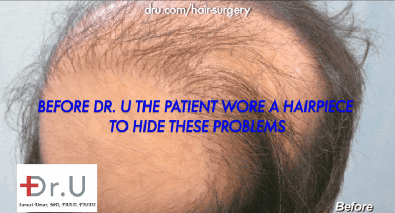 No hair growth yield, oddly placed grafts caused this patient to wear a toupee for 14 years