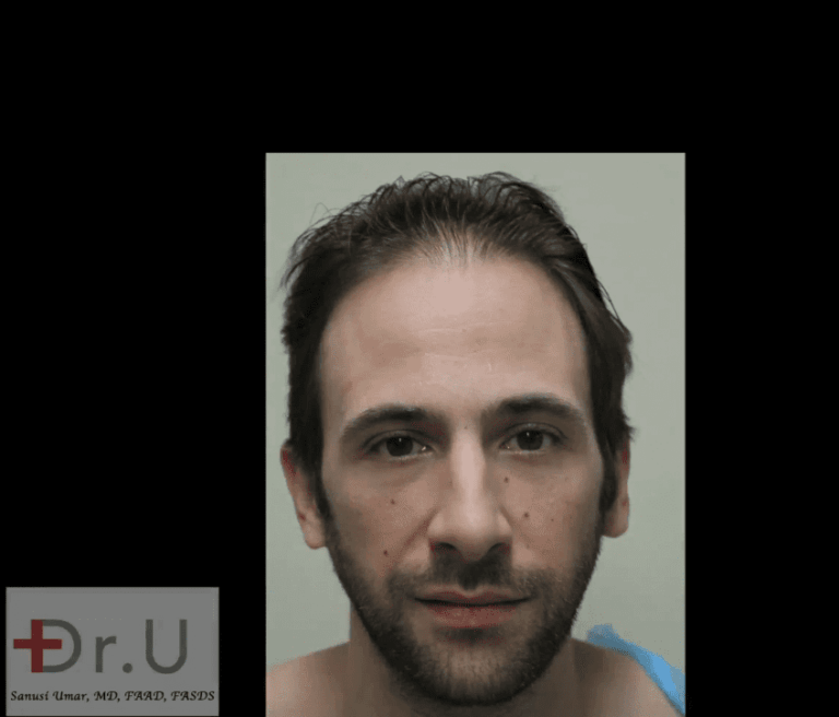 Celebrity hair restoration patient showing a receded hairline and temples before his procedure with Dr. Umar