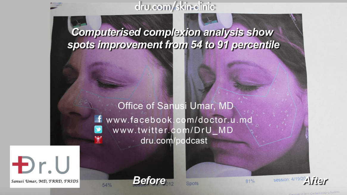  A single Fraxel Dual laser treatment allows doctors to remove age spots fast
