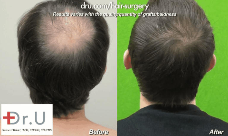 Hollywood, Los Angeles patient shown from the side before and after his celebrity hair restoration