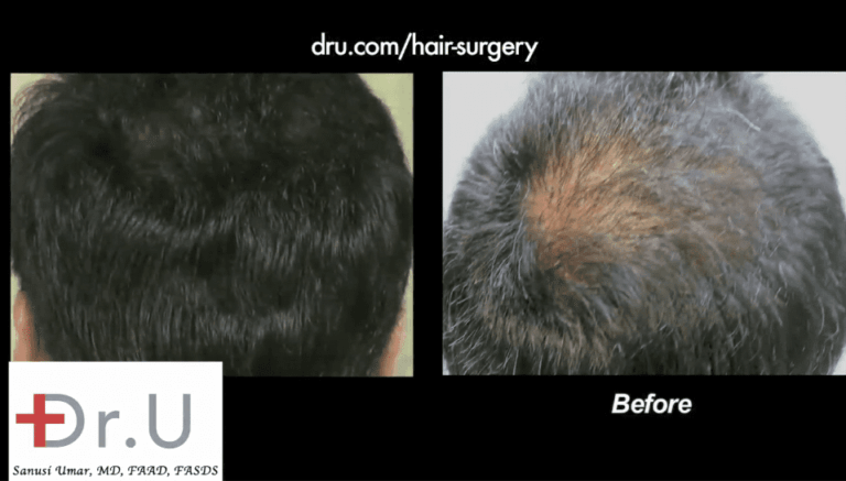 Beard hair grafts were inserted into the patient's sparse crown to produce the abundant density shown here