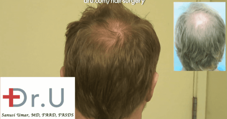 crown hair loss reversed along with treatment for advanced hairline recession