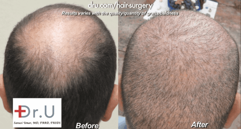 Patient who wanted to repair strip surgery mistakes showed continued baldness in the crown before his procedure with Dr. Umar. This area was successfully filled in using an expanded donor pool 