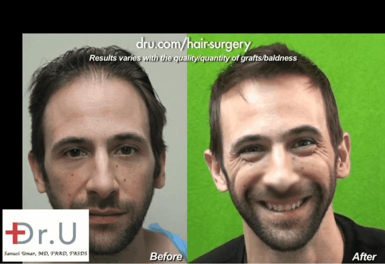 Hair restoration can be a transformational course of action when it comes to image management for celebrities 