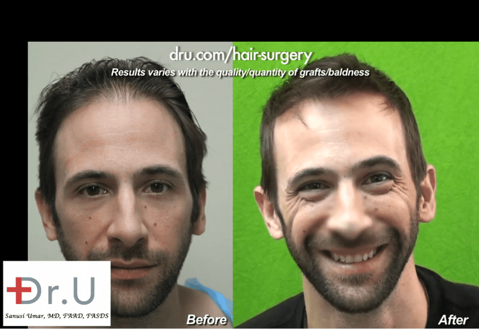 Celebrity hair transplants can produce amazing transformations. Bernardo de Paula before and after his hair restoration with Dr. Umar