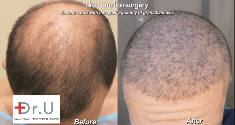 Sydney, Australia patient showed no growth after strip surgery but overcame this issue with 13,000 grafts of head and body hair
