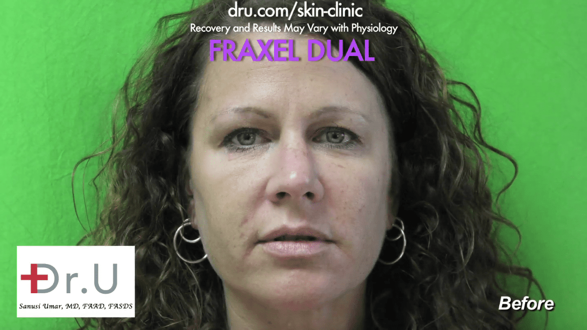 With Fraxel Dual laser, it is possible to get rid of brown spots caused by sun and aging.*