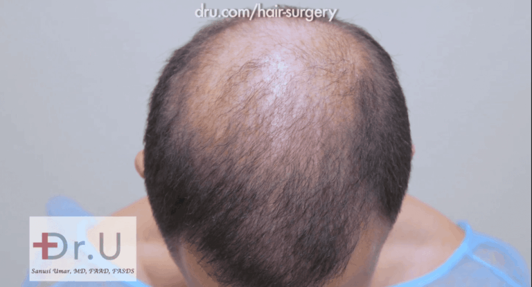 This patient was faced with not enough hair transplant donor grafts due to the limited hair left on his head