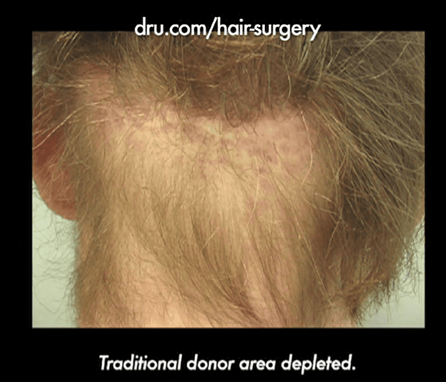 This patient's experience of hair transplant surgery gone wrong multiple times left him with his traditional donor area depleted*